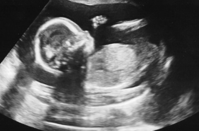 4d-ultrasound-demon-640x422